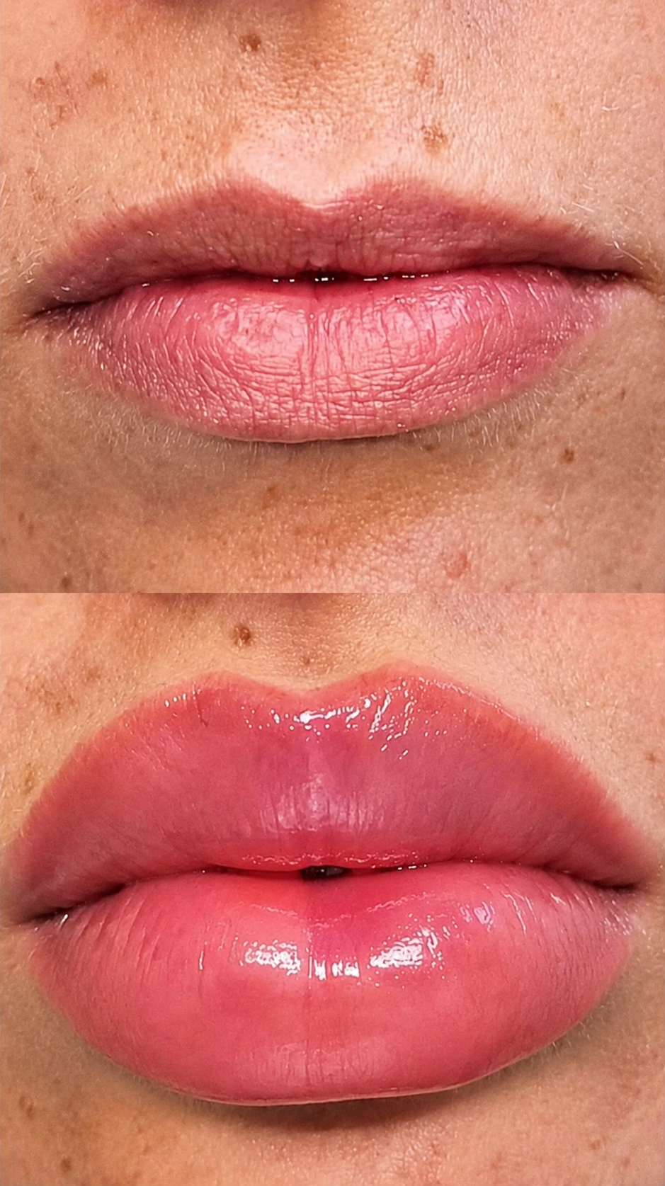 Resultado real de tratamiento estético de labios