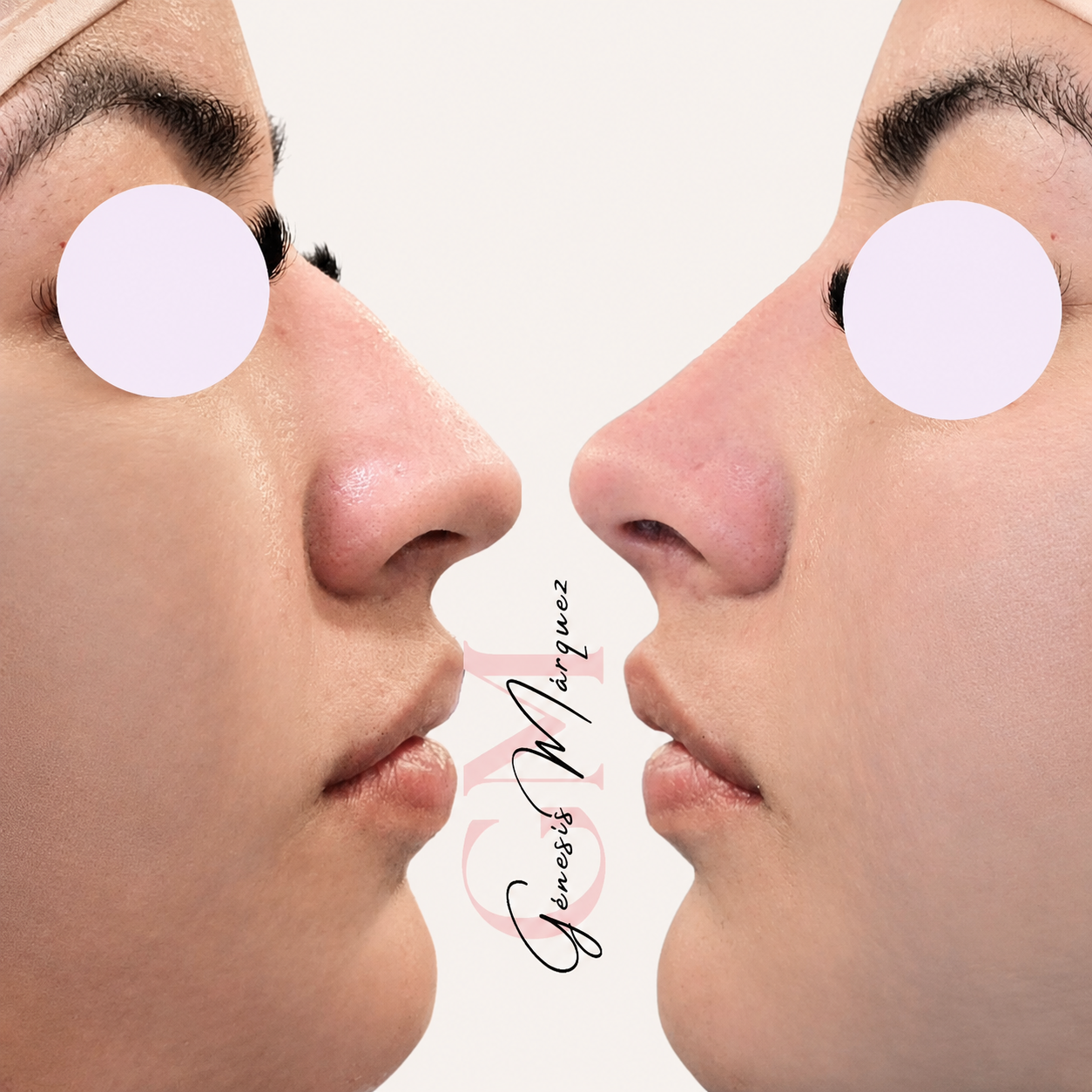 Resultado real de perfil estético facial