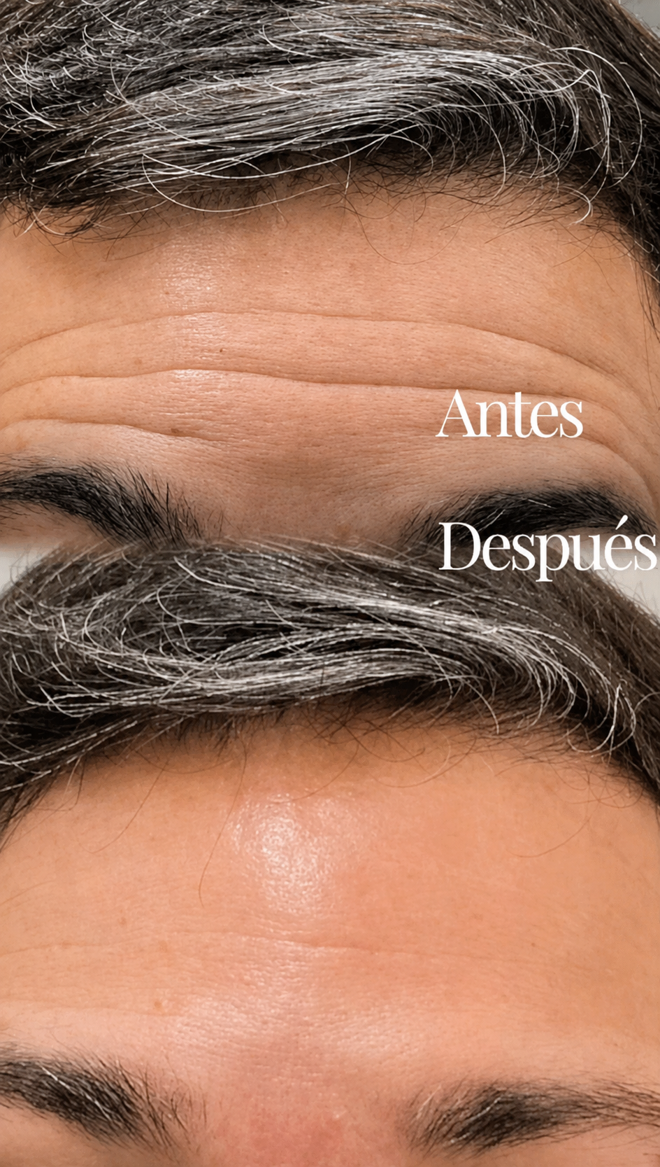 Antes y después real de tratamiento en frente