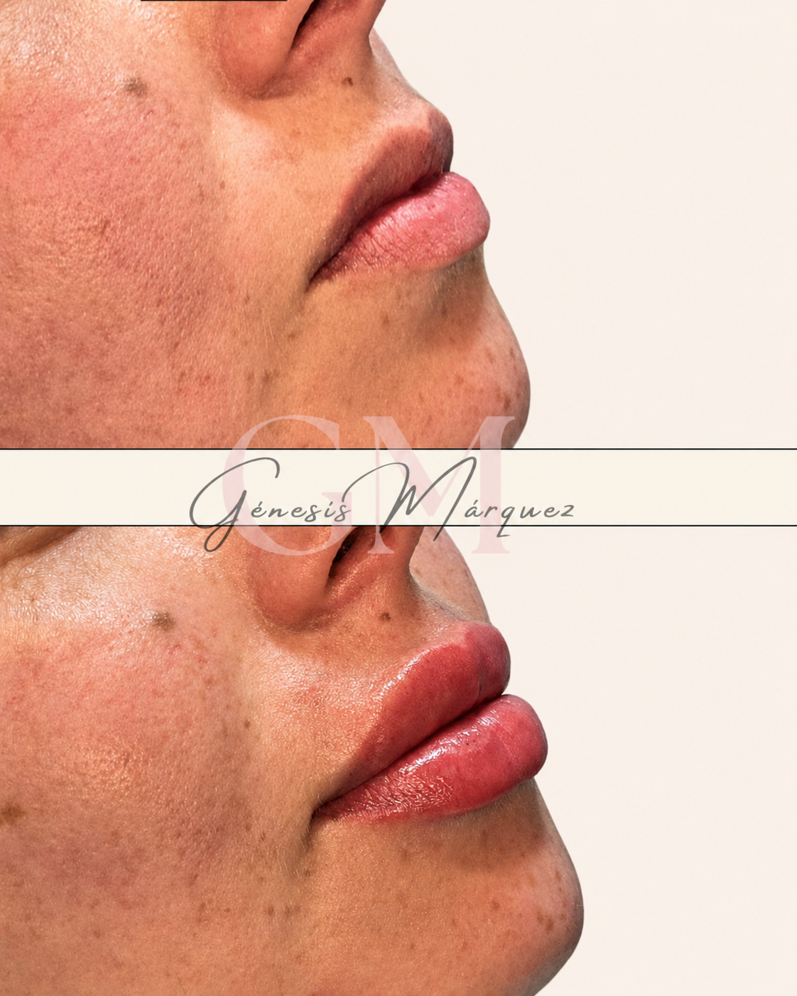 Resultado real de armonización de labios y perfil