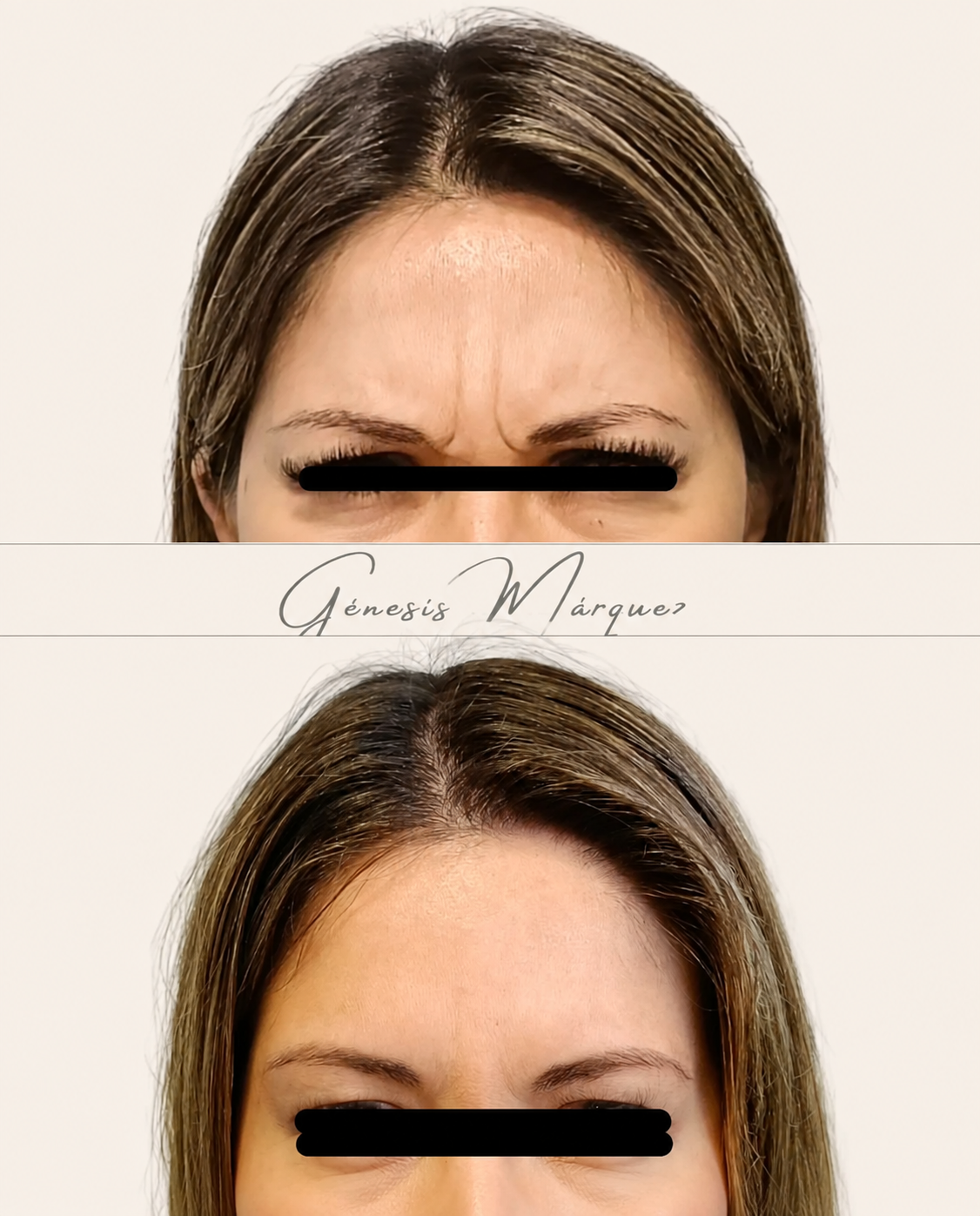 Antes y después real de tratamiento facial